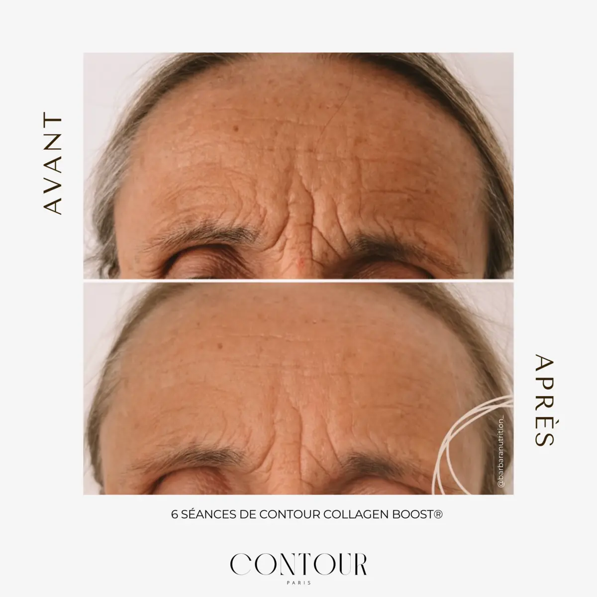 Collagen Boost : la radiofréquence anti-âge expliquée simplement
