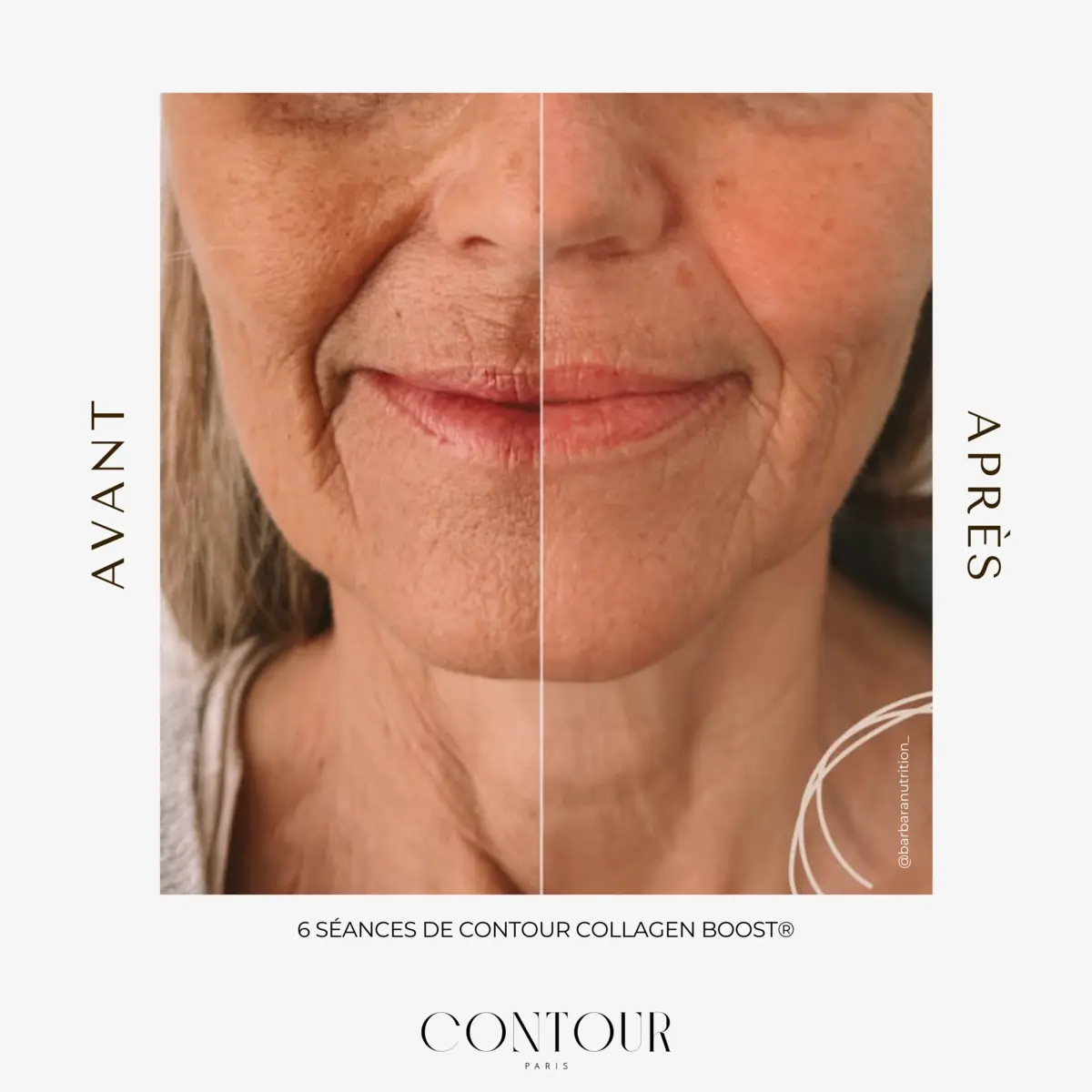 Avant / après Collagen Boost : taches et pores après une cure de 5 séances