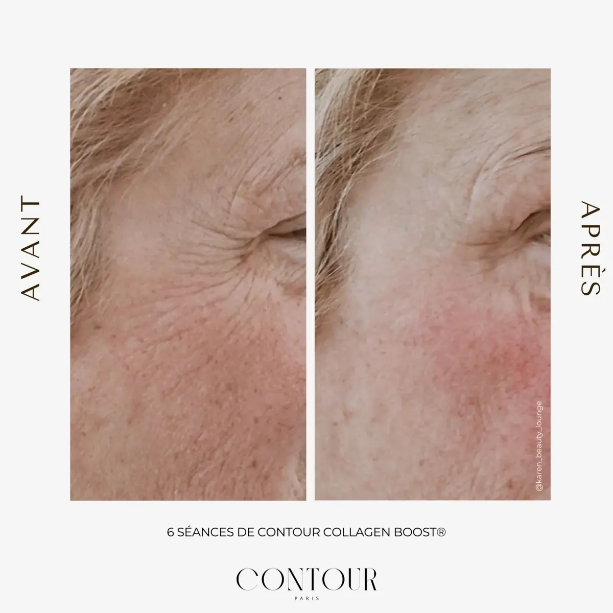 Avant / après Collagen Boost : effet coup d'éclat après une séance